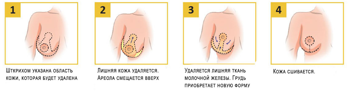 Подтяжка груди с имплантами